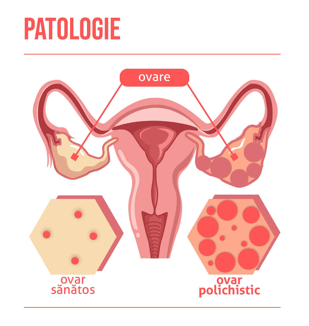 Sindromul ovarelor polichistice