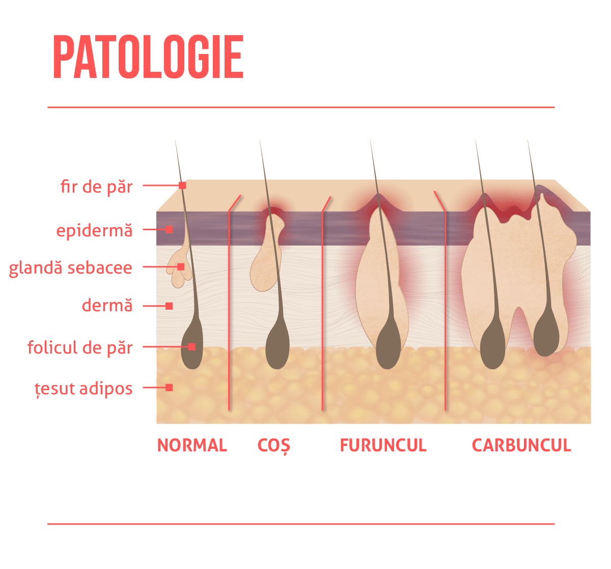 Furuncule și carbuncule