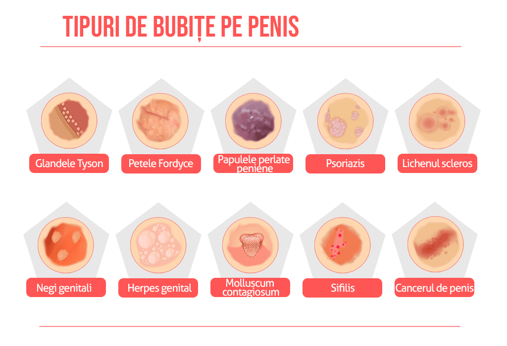 Bubițe pe penis