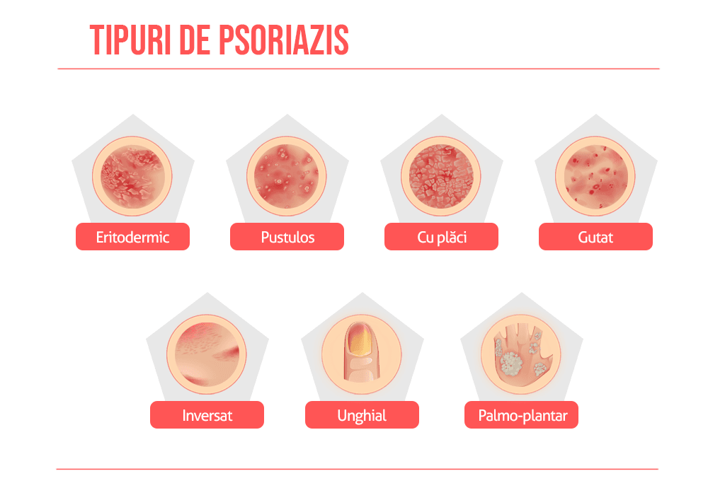 Psoriazis